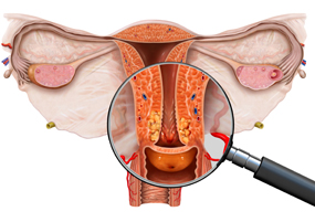 Anatomische Darstellung der Gebärmutter; eine Lupe liegt darüber und vergrößert den gebärmutterhals mit einer bösartigen Gewebeveränderung.