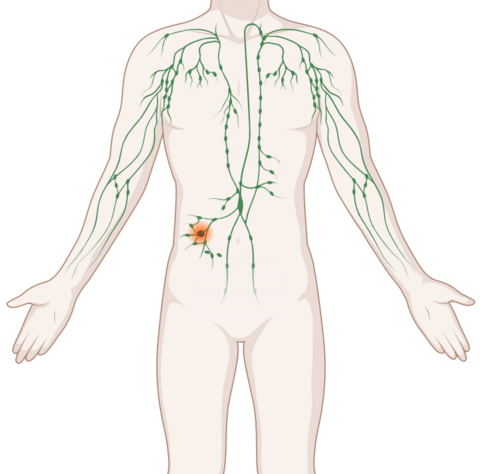 Schematische, anatomische Darstellung des lymphatischen Systems mit leuchtendem Tumor.
