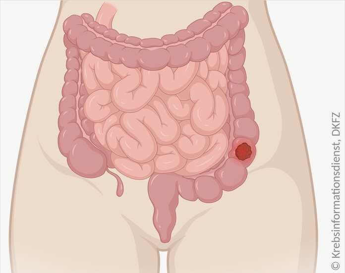 Schematische anatomische Abbildung des Darmtraktes mit leuchtendem Tumor im Dickdarm.