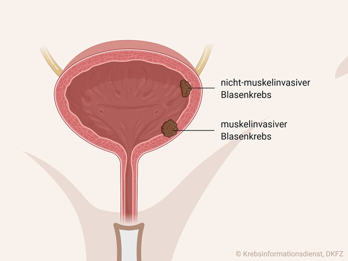 Nicht-muskelinvasiver Blasenkrebs ist auf die Blasenschleimhaut begrenzt, muskelinvasiver Blasenkrebs ist weiter in die Muskelschicht eingewachsen.