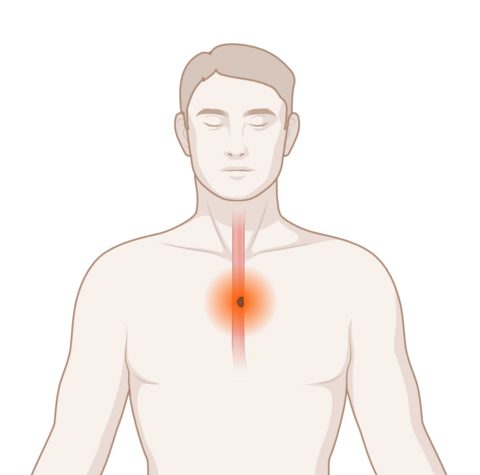 Schematische, anatomische Darstellung der Speiseröhre mit leuchtendem Tumor