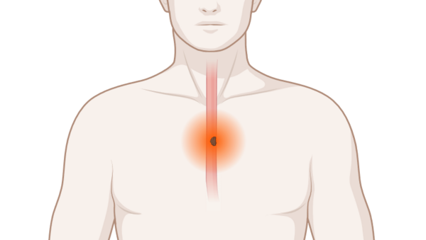 Schematische, anatomische Darstellung der Speiseröhre mit leuchtendem Tumor