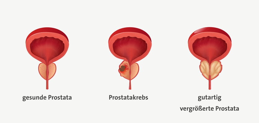 Infografik einer gesunden Prostata (links) im Vergleich zu einer Prostata mit einem bösartigen Tumor (mittig) und einer gutartig vergrößerten Prostata (rechts).