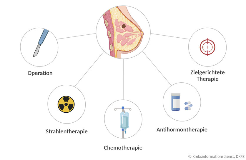 Mindmap der Behandlungsmöglichkeiten bei Brustkrebs: Operation, Strahlentherapie, Chemotherapie, Antihormontherapie, zielgerichtete Therapie.