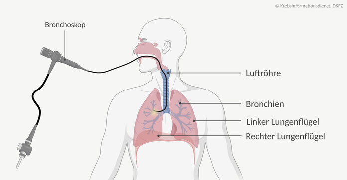 Bronchoskopie: Der biegsame Schlauch des Bronchoskops wird durch den Mund, durch die Luftröhre bis hin die Bronchien vorgeschoben.