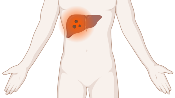 Schematische, anatomische Darstellung des Körpers mit mehreren leuchtenden Tumoren (Metastasen) in der Leber.