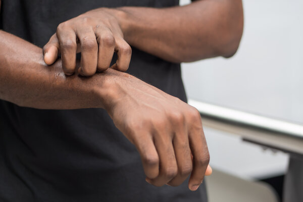 Eine Hand kratzt die Haut am Unterarm wegen Hautjucken