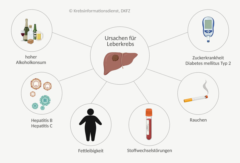 Die häufigsten Ursachen für Leberkrebs sind: Alkoholkonsum, chronische Infektionen mit Hepatitis C und Hepatitis B, Fettleibigkeit, Stoffwechselstörungen, Rauchen und die Zuckerkrankheit.