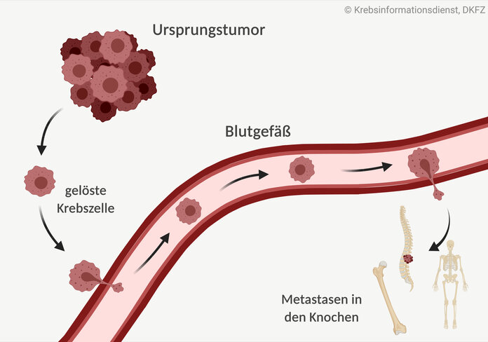 Graphische Darstellung zur Entstehung von Knochenmetastasen: Tumorzellen lösen sich vom Ursprungstumor ab, wandern in die Blutgefäße und von dort in die Knochen.