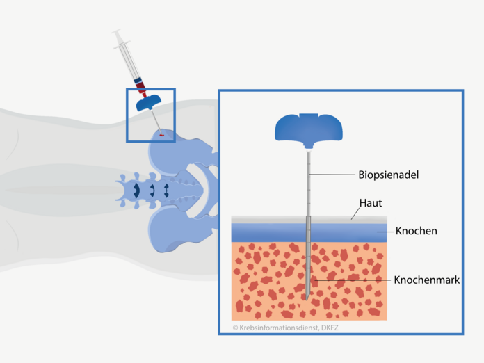 Bei der Knochenmarkuntersuchung wirde eine Biopsienadel durch die Haut in den Beckenknochen gestochen und das Knochenmark angesaugt.