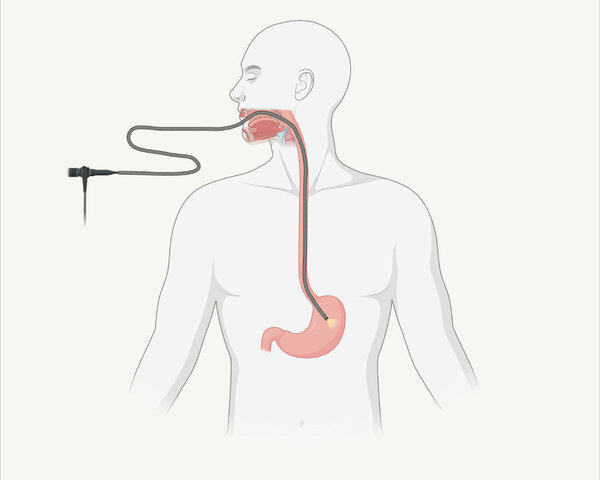 Schematische Darstellung, wie der Schlauch bei einer Magenspiegelung durch die Speiseröhre bis in den Magen verläuft.