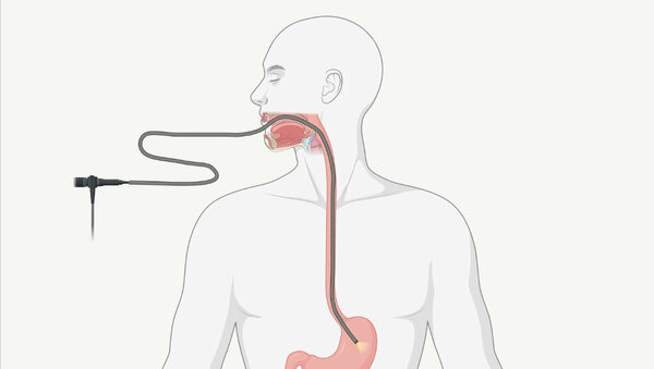 Schematische Darstellung, wie der Schlauch bei einer Magenspiegelung durch die Speiseröhre bis in den Magen verläuft.