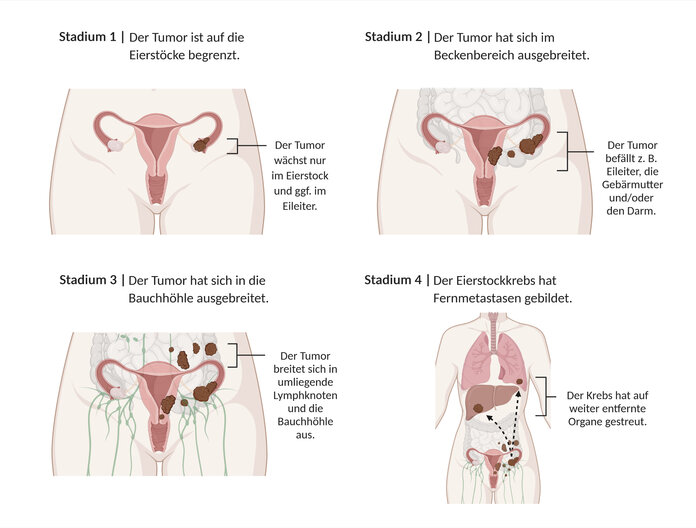 Grafische Darstellung der Stadieneinteilung bei Eierstockkrebs – Stadium 1: Der Tumor ist auf die Eierstöcke begrenzt, Stadium 2: Der Tumor hat sich im Beckenbereich ausgebreitet, Stadium 3: Der Tumor hat sich in die Bauchhöhle ausgebreitet, Stadium 4: Der Eierstockkrebs hat Fernmetastasen gebildet.