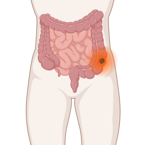 Darmkrebs: anatomische Darstellung mit leuchtendem Tumor