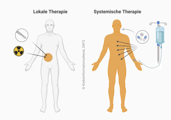 Lokaltherapie: Operation und Strahlentherapie, denn das sind Behandlungen, die sich auf einen Körperteil beschränken; Systemtherapie: Medikamente zum Schlucken oder als Infusion, denn sie wirken im ganzen Körper