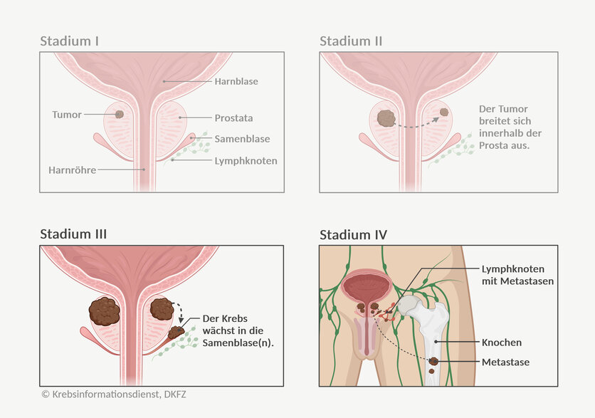 Graphische Darstellung der 4 Tumorstadien bei Prostatakrebs und die unterschiedliche Tumorgröße und Ausbreitung im Körper.