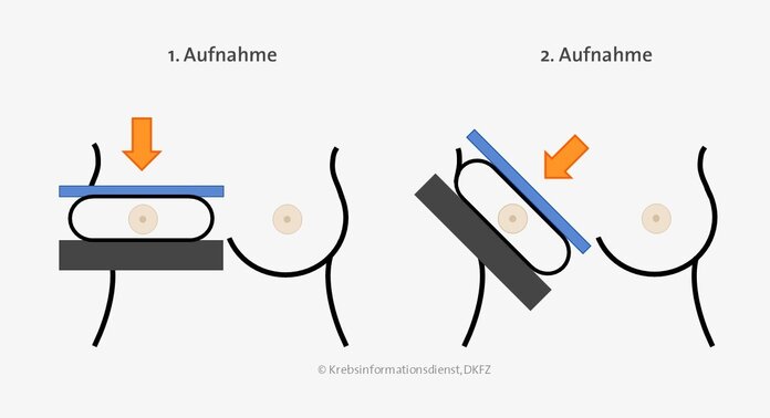 Eine Grafik, die zeigt, dass bei der Mammographie von jeder Brust 2 Aufnahmen gemacht werden: Eine grade Aufnahme von oben nach unten und eine schräge Aufnahme von innen nach außen.