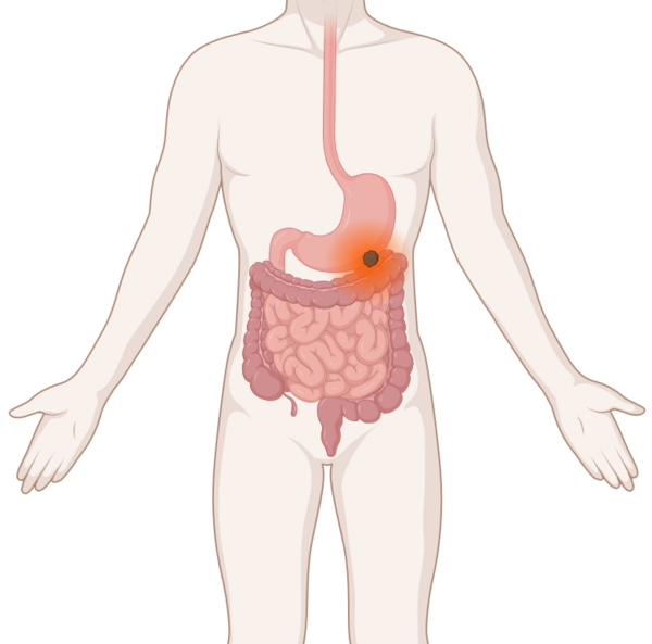 Schematische Darstellung der Verdauungsorgane mit leuchtendem Tumor im Magen.