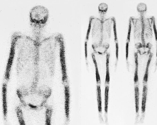 Schwarz-weiße, schemenhafte Darstellung eines Skeletts