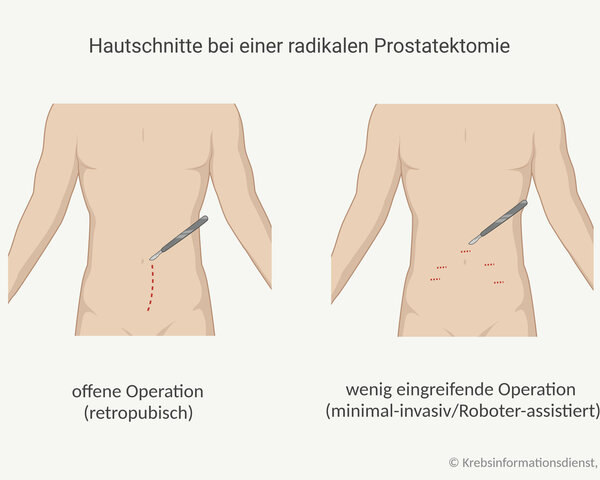 Grafische Darstellung der notwendigen Hautschnitte bei einer radikalen Prostatektomie: bei einer retropubischen Operation wird ein Längsschnitt zwischen Nabel und Schambein des Patienten gemacht. Bei einem wenig eingreifenden (minimal-invasiven) Vorgehen, wie der Roboter-assistierten OP, macht der Chirurg oder die Chirurgin mehrere kleine Schnitte in die Bauchdecke.