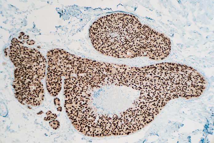 Gewebeprobe von Brustkrebszellen, deren Hormonbindestellen mit Antikörpern angefärbt sind. Die Zellkerne der Krebszellen sind braun gefärbt, gesunde Zellen erscheinen blau.