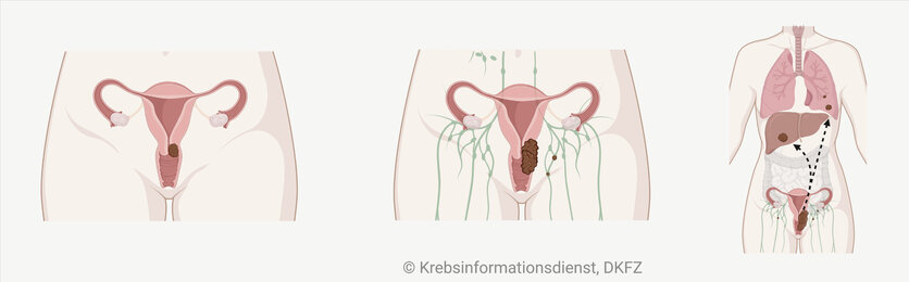 Anatomische Darstellung eines örtlich begrenzten Tumors, örtlich fortgeschrittenen Tumors und Fernmetastasen bei Gebärmutterhalskrebs.