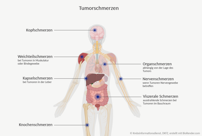 Anatomische Ansicht eines Menschen, an dem verschiedene Formen von Tumorschmerzen gekennzeichnet sind: Organschmerzen am Gehirn, Nervenschmerzen am Nerven des Armes, Viszerale Schmerzen im Magen-Darm-Trakt, Knochenschmerzen im Oberschenkelknochen, Kapselschmerzen in der Leber, Weichteilschmerzen im Schultermuskel.