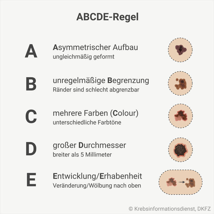 Eine Grafik zeigt die ABCDE-Regel: A steht für einen asymmetrischen Aufbau, B für eine unregelmäßige Begrenzung, C für Colour – verschiedene Farben, D für einen großen Durchmesser und E für Erhabenheit oder Entwicklung.