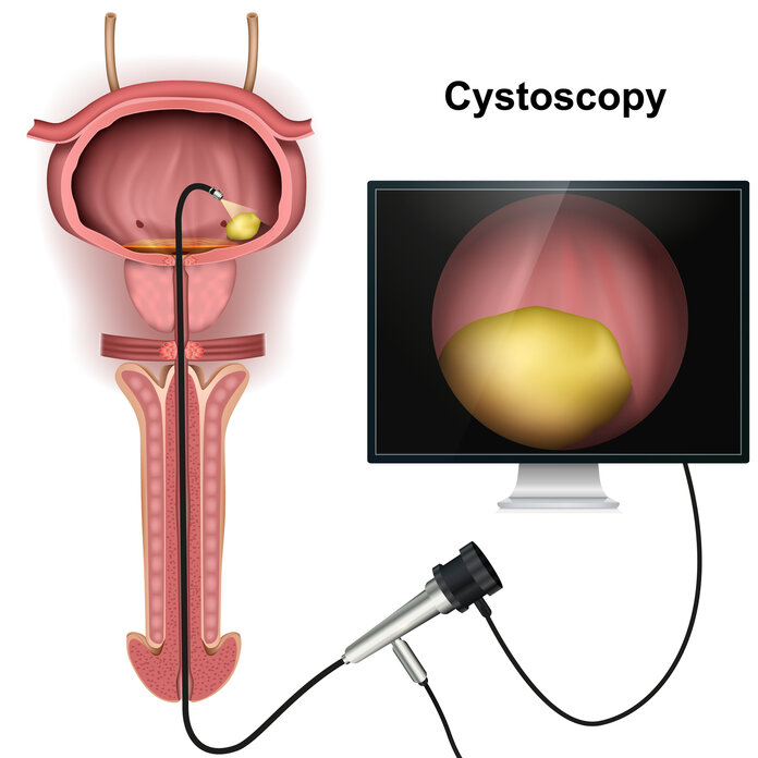 Anatomische Darstellung der Harnblase und Harnröhre beim Mann mit einem Untersuchungsgerät zur Blasenspiegelung (Zystoskop). Daneben ist ein vergrößerter Blasentumor auf einem Computer-Monitor dargestellt.