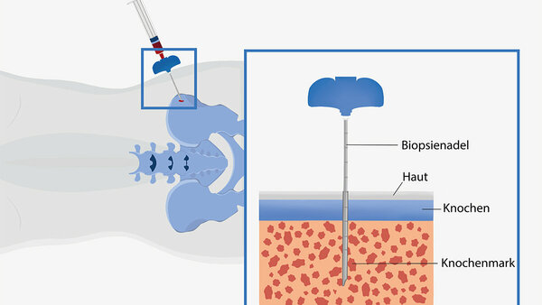 Bei der Knochenmarkuntersuchung wirde eine Biopsienadel durch die Haut in den Beckenknochen gestochen und das Knochenmark angesaugt.