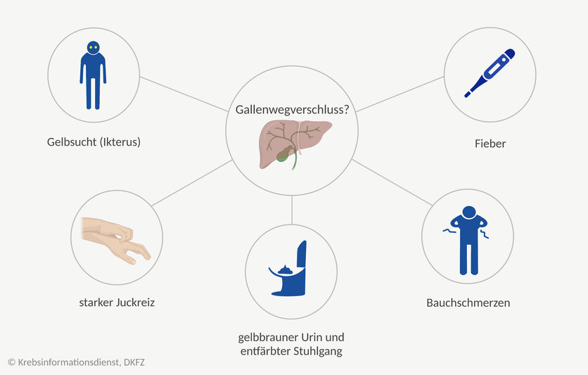 Mindmap mit Symptomen bei einem Gallenwegverschluss: Gelbsucht, starker Juckreiz der Haut, gelbbrauner Urin und entfärbter Stuhlgang, Bauchschmerzen und Fieber.