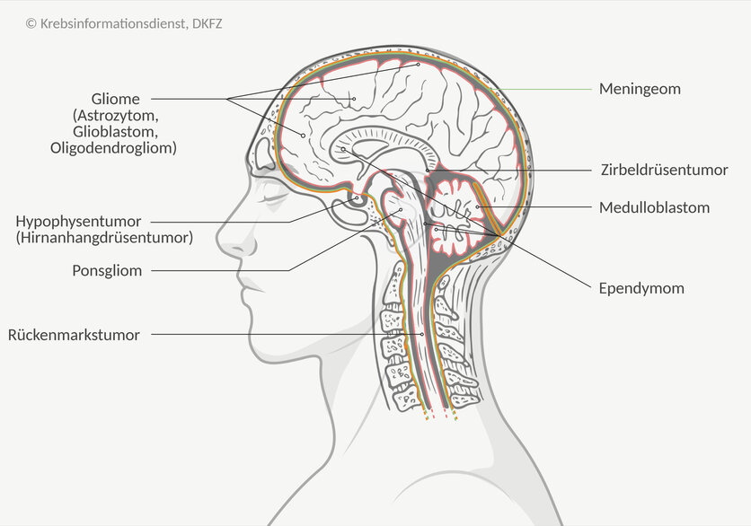 Es gibt verschiedene Arten von Hirntumoren, die in unterschiedlichen Bereichen des Gehirns entstehen können, unter anderem Gliome, Meningeome, Neurinome oder Rückenmarkstumoren.