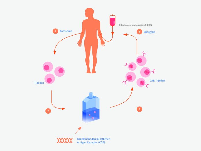 Schematische Darstellung des Ablaufs einer CAR-T-Zell-Therapie