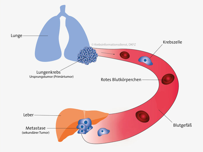 Von einem Tumor in der Lunge können sich Krebszellen ablösen und über die Blutbahn in die Leber gelangen. Entwickelt sich in der Leber ein neuer Tumor, sprechen Ärzte von einer Metastase.