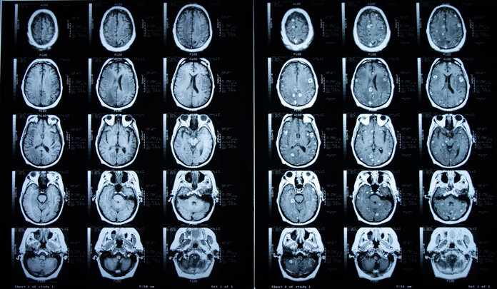 Aufnahme einer Magnetresonanztomographie (MRT) des Gehirns mit (rechts) und ohne (links) Kontrastmittel.