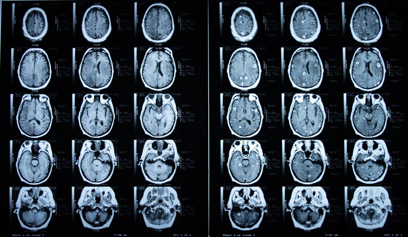 Aufnahme einer Magnetresonanztomographie (MRT) des Gehirns mit (rechts) und ohne (links) Kontrastmittel.