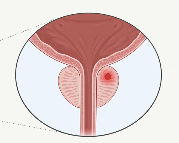 Grafische Darstellung der Lage der Geschlechtsorgane, Harnblase, Harnröhre. In der Prostata befindet sich ein Tumor (rot).