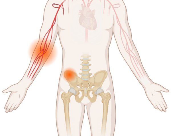 Schematische, anatomische Darstellung des Körpers mit leuchtenden Tumoren an Blutgefäßen und Beckenknochen.