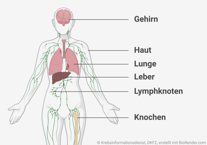 grafische Darstellung von Organen und Geweben, in die Krebs häufig metastasiert