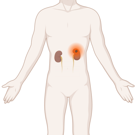 Schematische, anatomische Darstellung der Nieren mit leuchtendem Tumor.