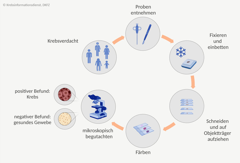 Ablaufschema einer histologischen Untersuchung: Besteht der Verdacht auf eine Krebserkrankung, wird der oder dem Betroffenen Gewebeproben entnommen. Die Proben werden fixiert, eingebettet, in hauchdünne Scheiben geschnitten und auf Objektträger aufgebracht. Anschließend werden die Proben gefärbt und unter dem Mikroskop begutachtet. Sind die Zellen gesund, ist der Befund negativ. Handelt es bei dem Gewebe um Krebs, ist der Befund positiv.