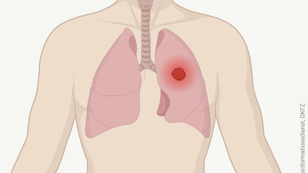 Grafik eines menschlichen Oberkörpers mit Lunge und Luftröhre. Ein Tumor in der Lunge ist als leuchtender Punkt dargestellt.