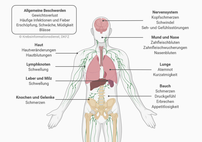 Anatomische Abbildung eines Menschen mit Zuordnung verschiedener Leukämie-Symptome.