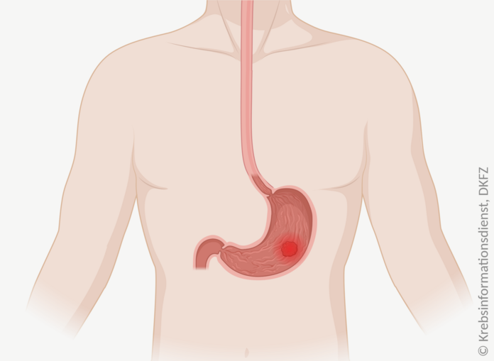 Silhouette eines Oberkörpers mit Magen und Speiseröhre. Im Magen befindet sich ein Tumor.