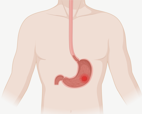 Silhouette eines Oberkörpers mit Magen und Speiseröhre. Im Magen befindet sich ein Tumor.