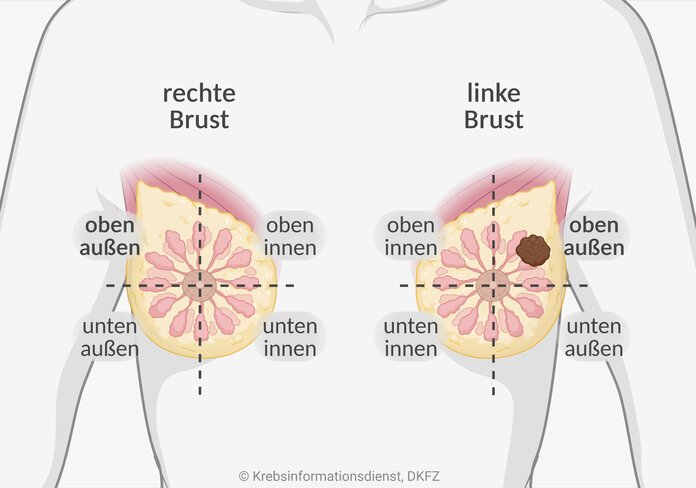 Grafische Darstellung der weiblichen Brüste, die jeweils durch eine senkrechte und eine waagerechte Linie, die sich auf der Brustwarze kreuzen, in Viertel eingeteilt werden.