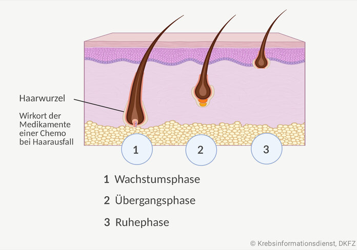 Graphische Darstellung der drei Phase des Haarzyklus: 1. Wachstumsphase, 2. Übergangsphase und 3. Ruhephase. Die Haarwurzel ist beschriftet: Wirkort der Medikamente einer Chemo bei Haarausfall.