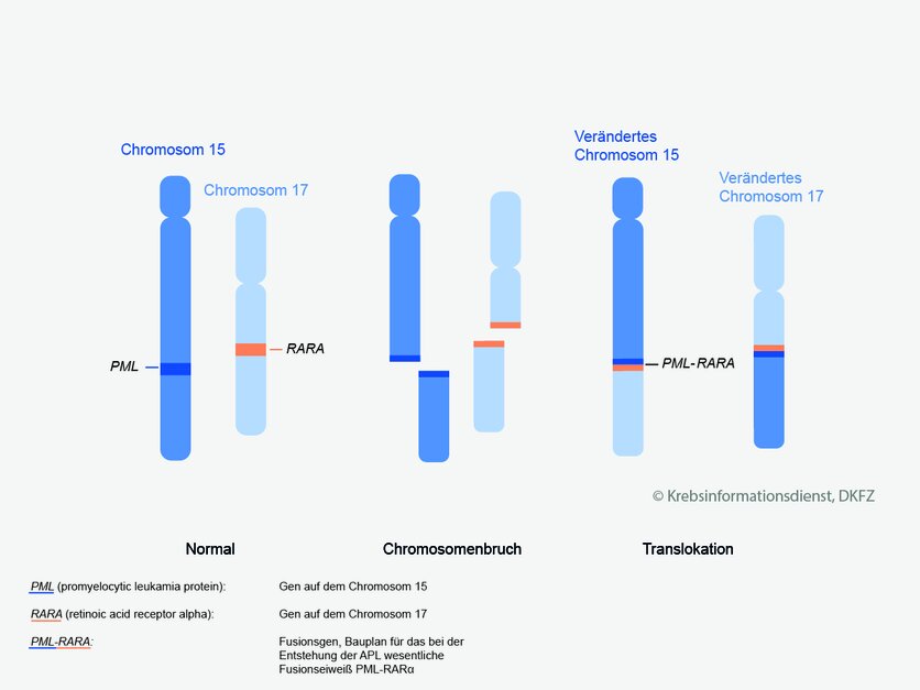 Translokation bei der ALP und Bildung von PML-RARA