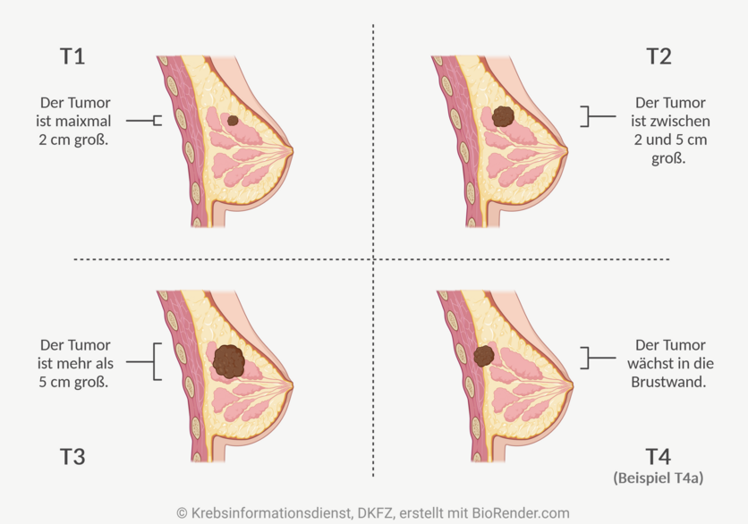 Infografik der Einteilung des T-Status der TNM-Klassifikation: Je größer der Tumor in der Brust, desto höher in der Regel das Tumorstadium.