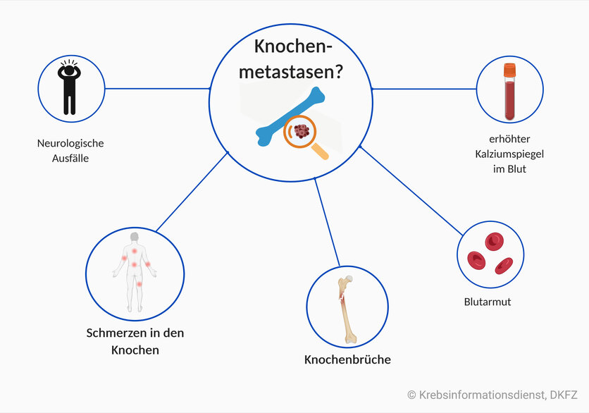 Symptome bei Knochenmetastasen: Schmerzen in den Knochen, Knochenbrüche, neurologische Ausfälle; auch Blutarmut oder ein erhöhter Kalziumspiegel können auf Knochenmetastasen hinweisen.